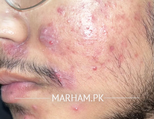 Acne Problem