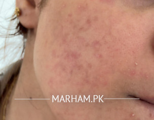 Barrier Damage After Using Clindamycin 