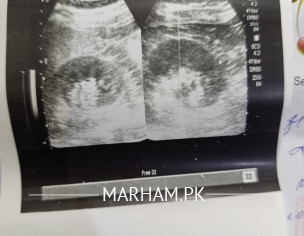 Kidney Stone Issue
