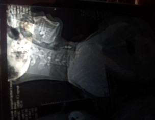 Neck Vein (tag As Much Doctor U Can)