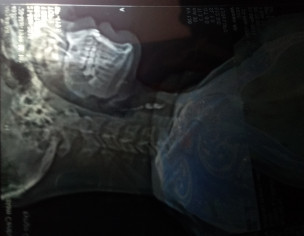 Neck Vein (tag As Much Doctor U Can)