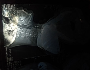 Neck Vein (tag As Much Doctor U Can)