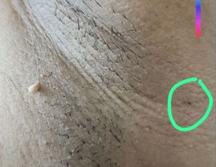 Feel Looks Like  Lump In My Armpit