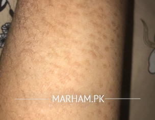 Skin Problem 