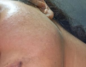 Hyperpigmentation On Sides Of Lips Through Chin