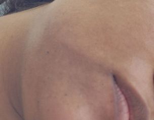 Hyperpigmentation On Sides Of Lips Through Chin