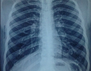 X Ray Findings