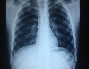 X Ray Findings