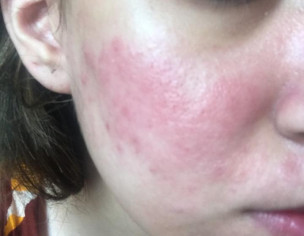 Severe Reaction Of Duac Gel