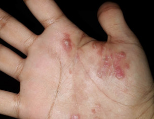 Psoriasis, Baalchar, Facial Hair Loss/hard Bumps Under Cheeks(plain On Surface)