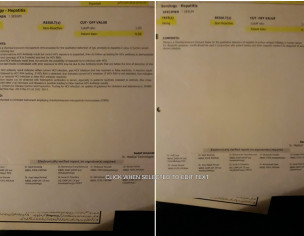 Psoriasis, Baalchar, Facial Hair Loss/hard Bumps Under Cheeks(plain On Surface)