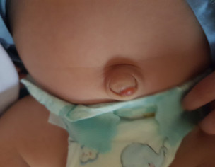 Umbilical Granuloma 