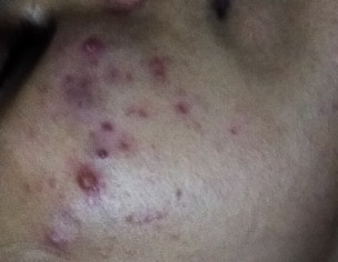 Acne, Pcos