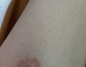 Itchy Rashes