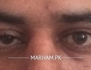 Thyroid Ophthalmopathy 