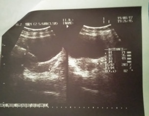 Pregnancy Or No Pregnancy