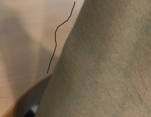 Having Multiple Small Lipoma 