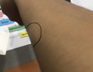 Having Multiple Small Lipoma 