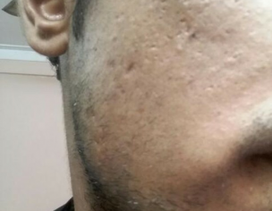 Skin.. Acne Scars, White-heads 