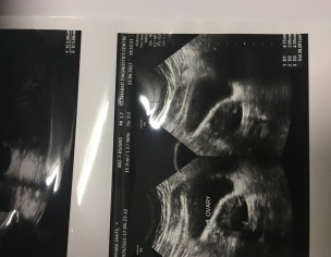 4 Cm Fibroid In Cervix