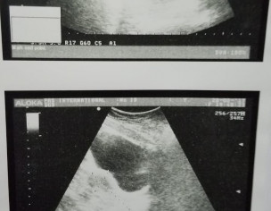 Periods Irregularity 