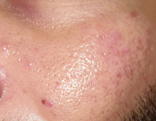 Acne, Acne Scars, Redness Around The Nose