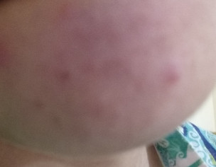 Skin Whitening &amp; Acne Problem