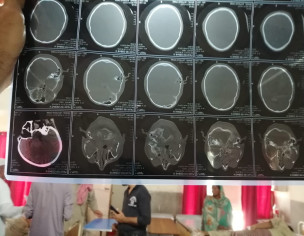 Accidental Neuro Recovery