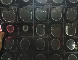 Accidental Neuro Recovery