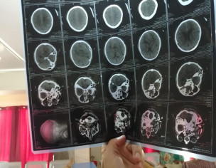 Accidental Neuro Recovery