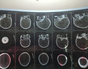 Accidental Neuro Recovery