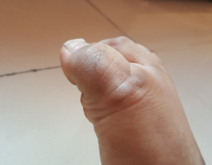 Black Mark On My Feet