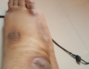Black Mark On My Feet