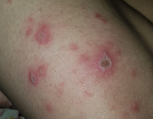 Anthraces On Upper Leg