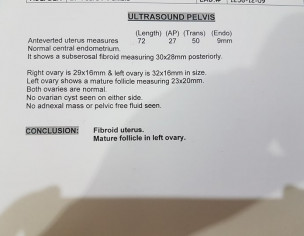 Fibroids And Fertility