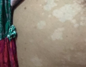 Infaction Around Breast