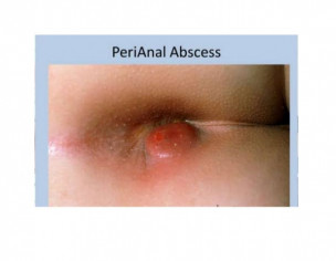 Peri Anal Abscess