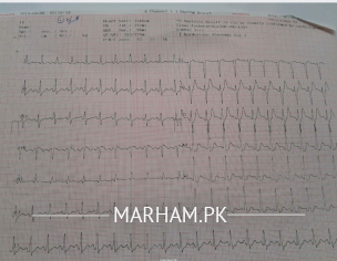 Check My ECG
