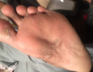 Allergy Due To Diabetes 