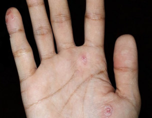 Right Hand Psoriasis