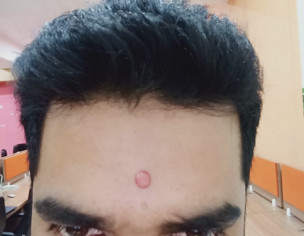 Cyst On Forehead 