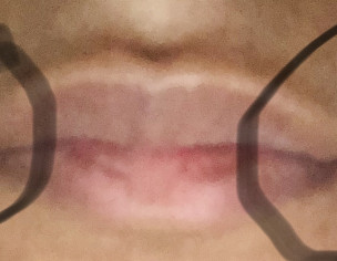 White-ish Area Around Lips
