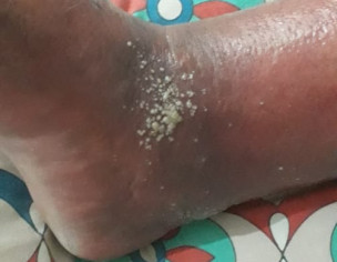 Skin Damage May Be Some Insect Bite Him