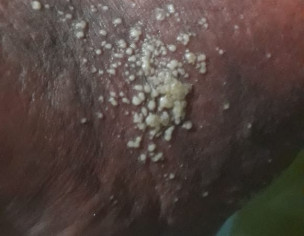 Skin Damage May Be Some Insect Bite Him