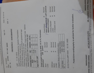 Hypoplastic Left Heart Syndrome 