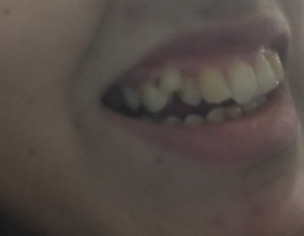 Doubling Of Teeth Milk Teath Still In My Mouth And Is Making The Real Teeth Go Backward From Its Real Position 