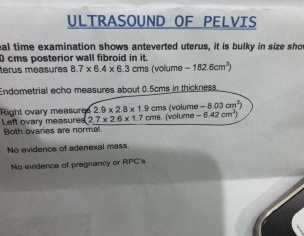 Posterior Wall Fibroid 