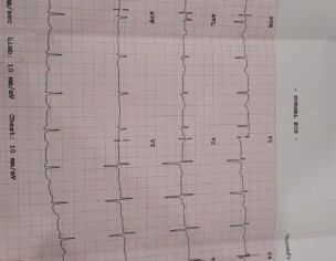 Ecg        