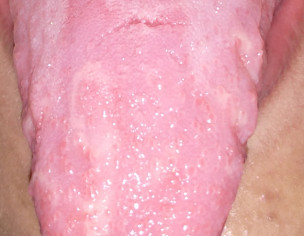 Tongue Fissures