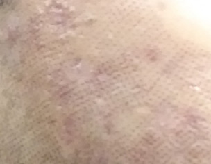 Recommend Me A Cream For Acne Marks